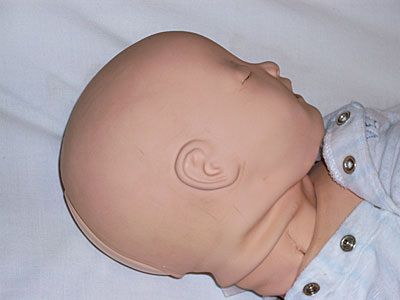 Repairing a tear in a Laerdal SimBaby's neck, this image shows the tear after the repair Repairing SimBaby with cyanoacrylate adhesive (after)